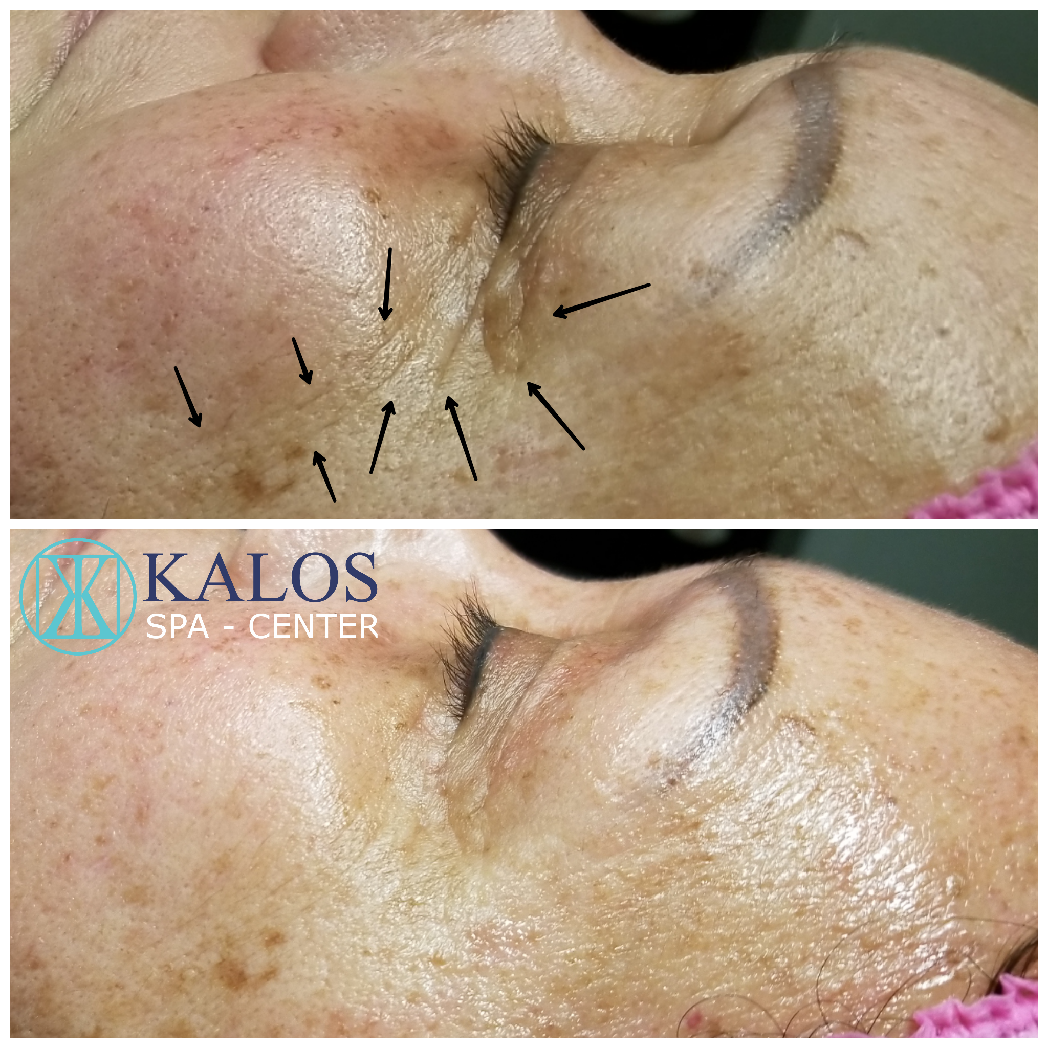 Image of a facial in Miami