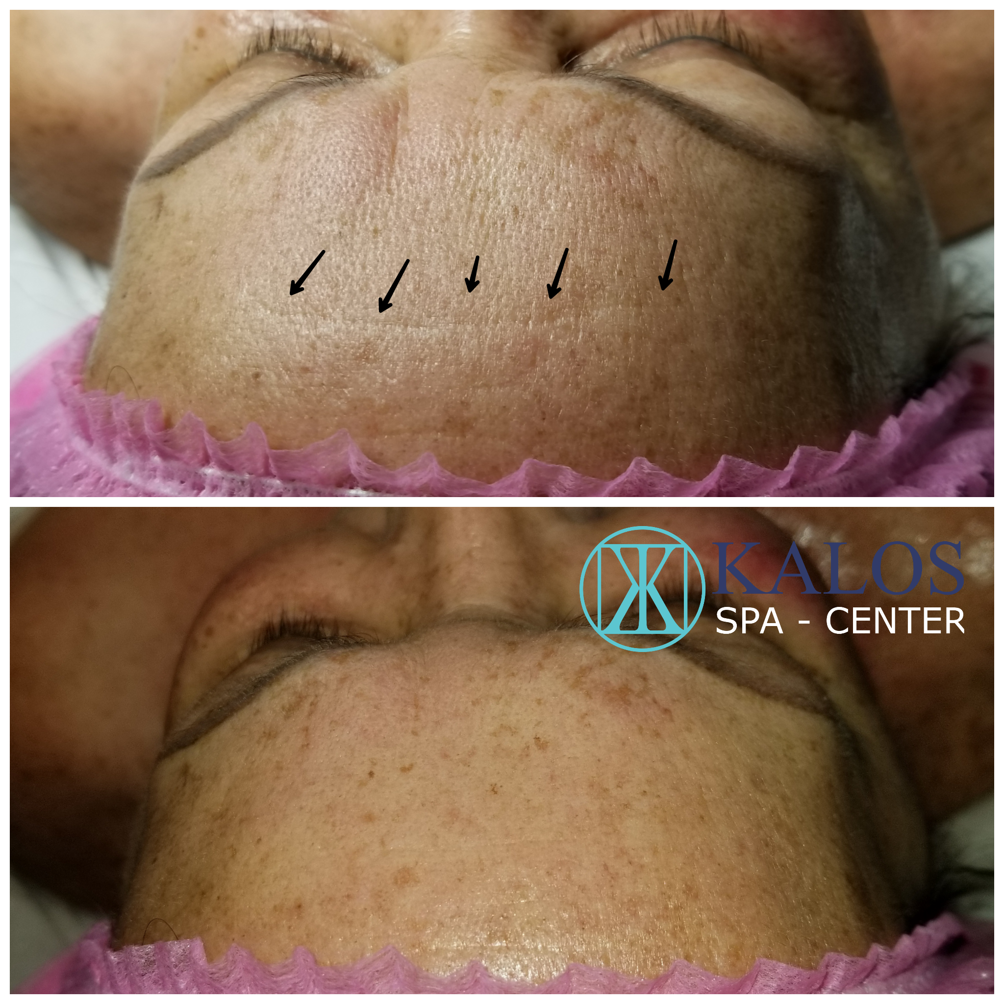 Image of a facial in Miami