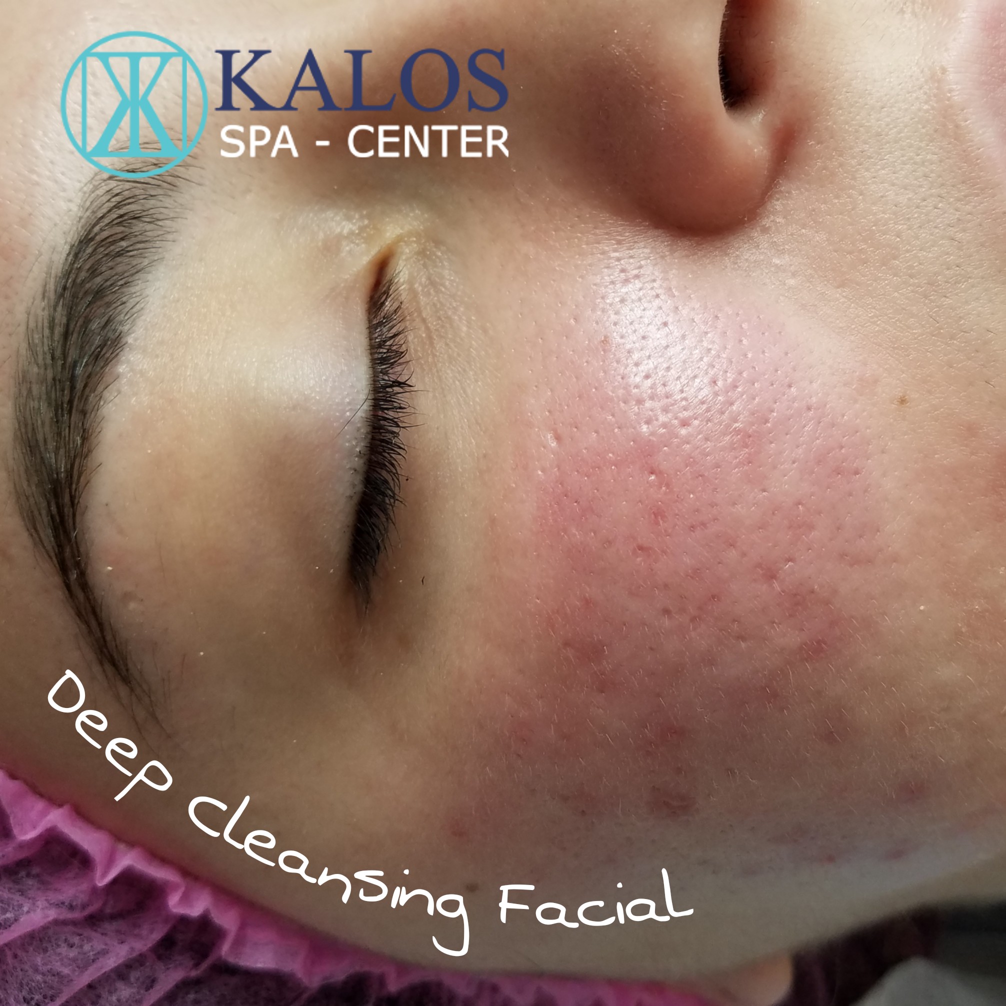 Image of a facial in Miami