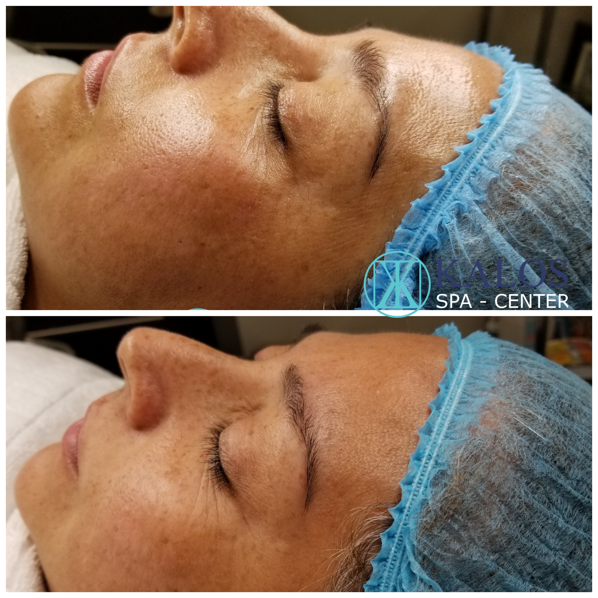 Image of a facial in Miami