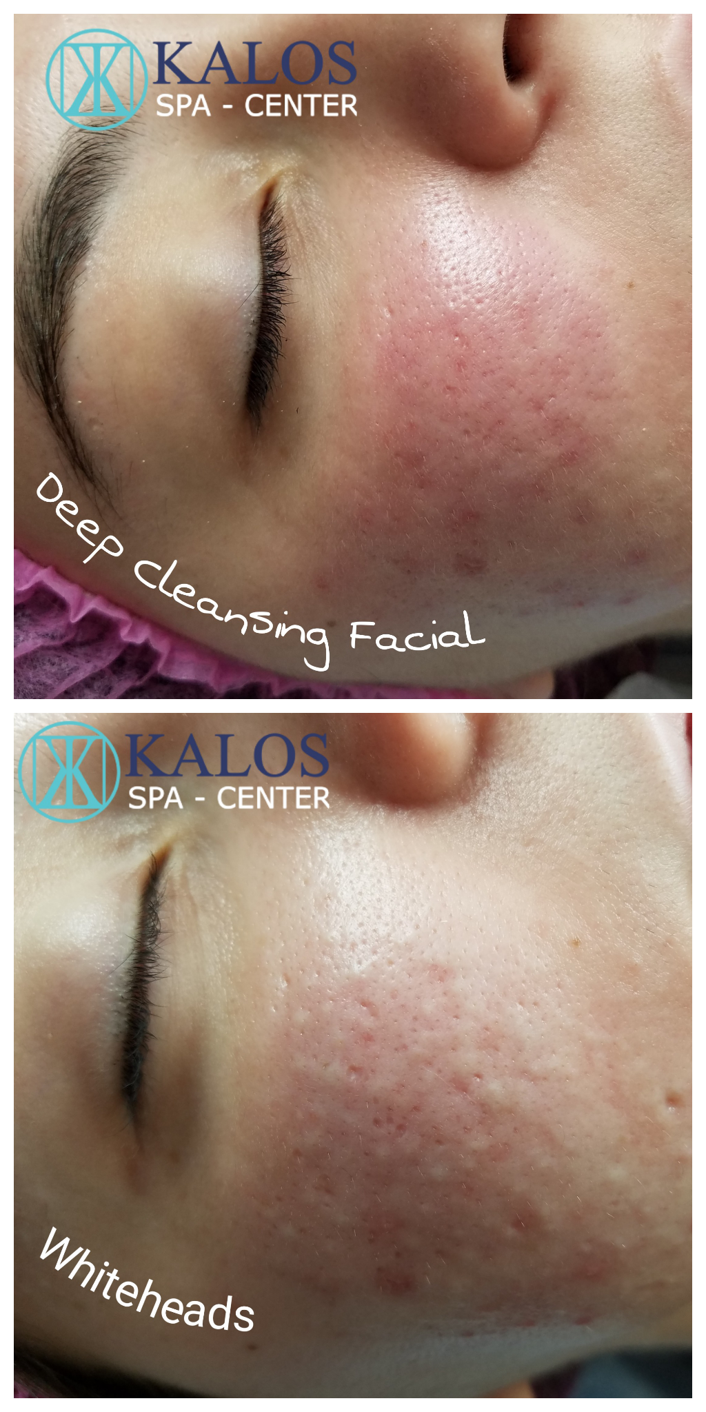 Image of a facial in Miami