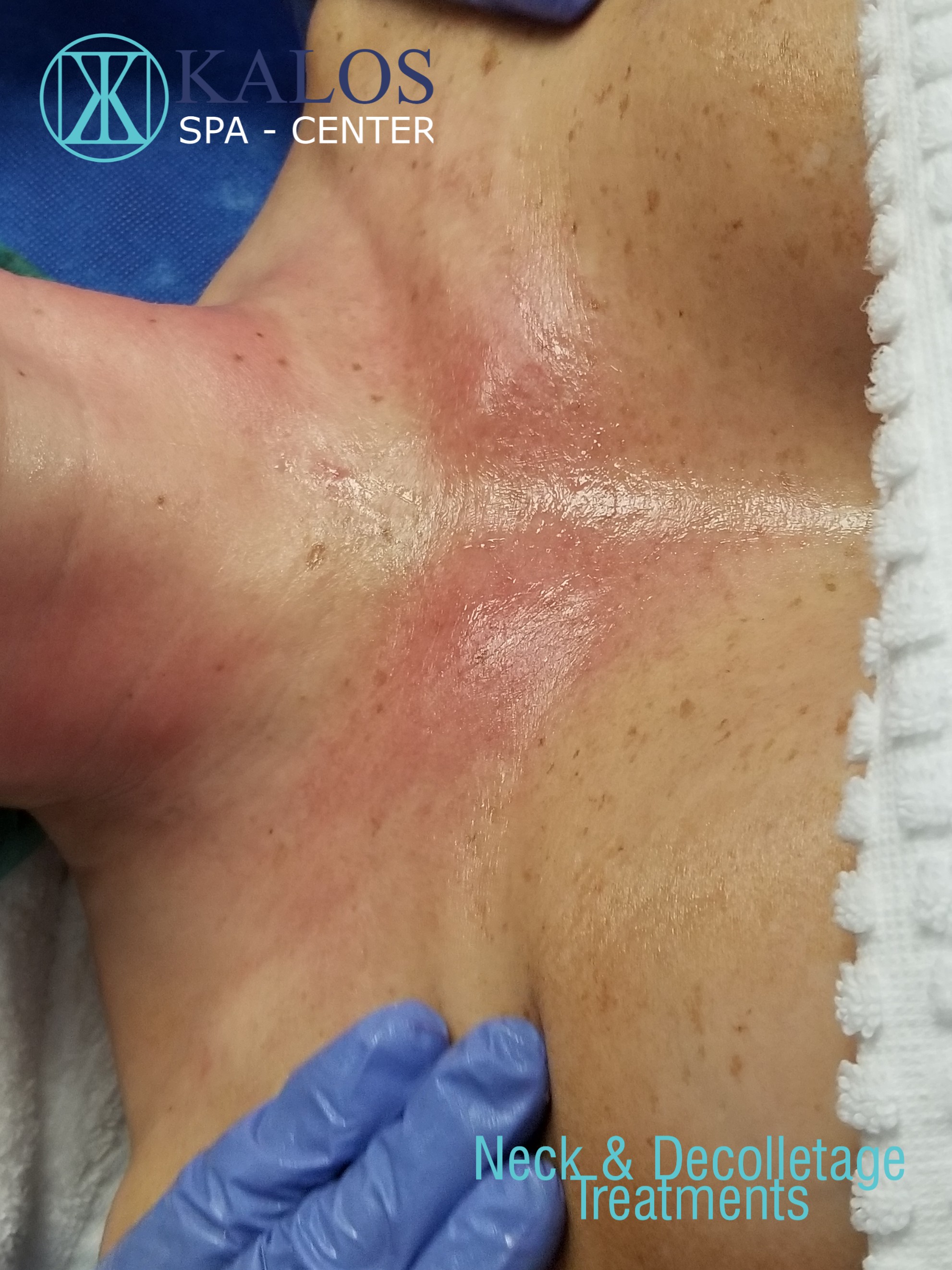 Image of a facial in Miami