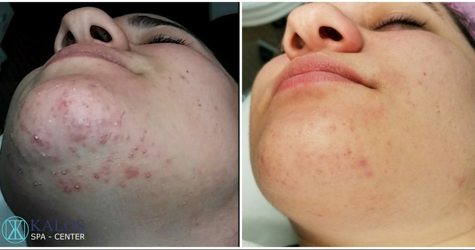 Image of a facial in Miami