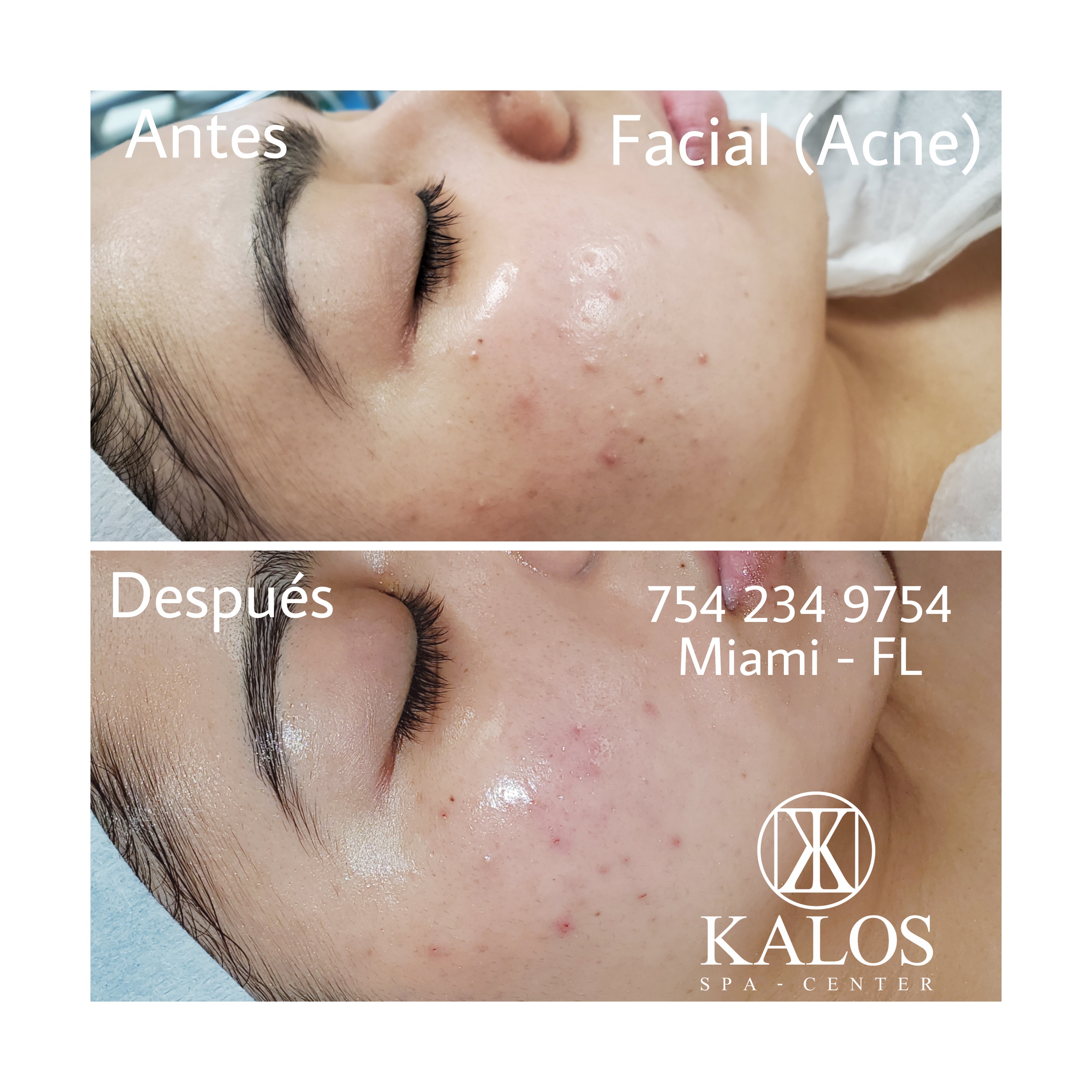 Image of a facial in Miami