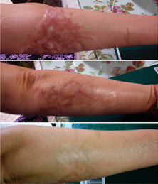 microneedles Miami Result