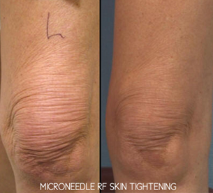 microneedles Miami Result