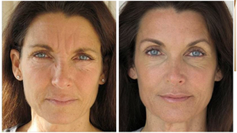 microneedles Miami Result