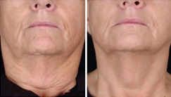 microneedles Miami Result