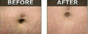 microneedles Miami Result